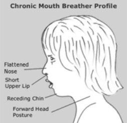 Oral rest posture: A key piece of the obstructive sleep apnea puzzle